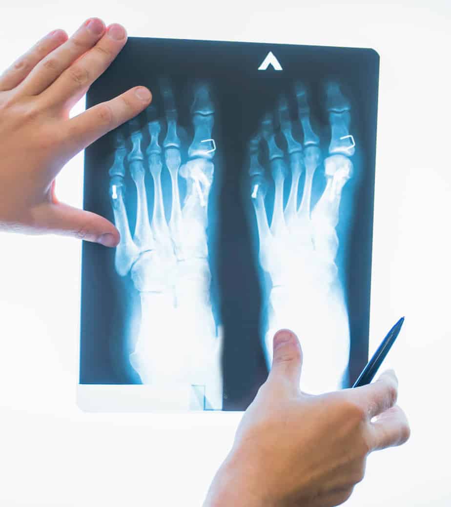 A person holding a pen and x-ray of feet.